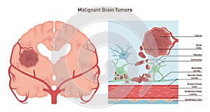 Brain cancer concept. Malignant tumor develops in the human brain.