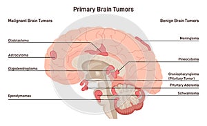 Brain cancer concept. Primary brain tumors types. Malignant cells develop