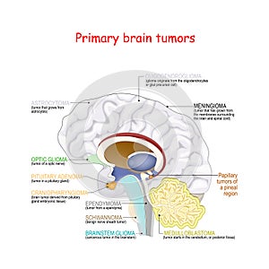 Brain cancer. different types of primary brain tumors
