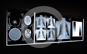 Brain and Chest X-ray on a Light Board