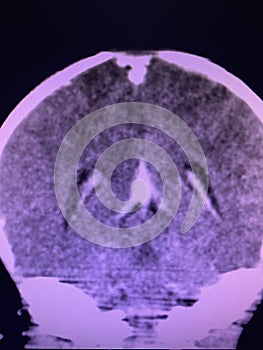 Brain computed tomography photo