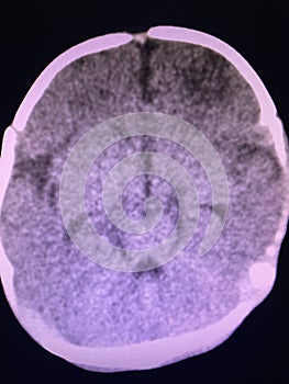 Brain computed tomography photo