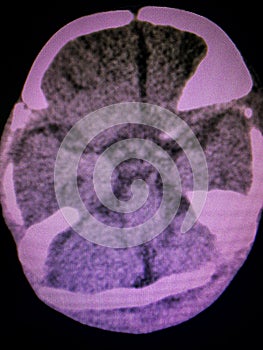 Brain computed tomography photo