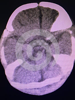 Brain computed tomography photo