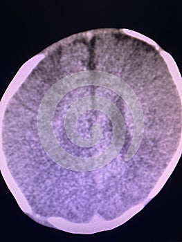 Brain computed tomography photo