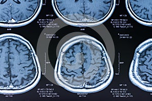 Brain ct scan