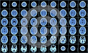 Brain CT Scan img