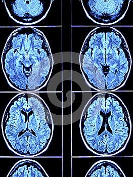 Brain CT Scan photo