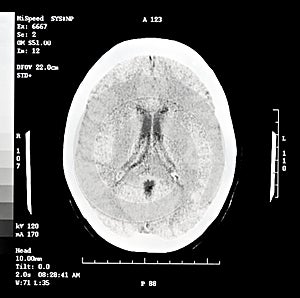 Brain CT Scan