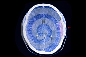 Brain CT scan, epidural hemorrhage