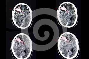 Brain CT scan, intracerebral hemorrhage