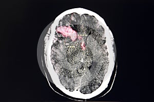 Brain CT scan, intracerebral hemorrhage photo