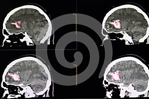 Brain CT scan, intracerebral hemorrhage photo
