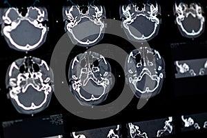 Brain CT scan x-ray film image Brain