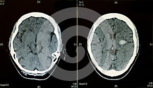 Brain CT scan showing bleeding stroke