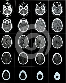 Brain CT scan showing brainstem cavernoma, right centrum semiovale developmental venous anomaly, intra cerebral haematoma, faint photo