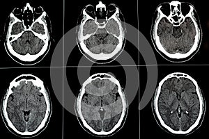 Brain CT scan showing brainstem cavernoma, right centrum semiovale developmental venous anomaly, intra cerebral haematoma, faint photo