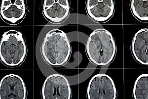 Brain CT scan showing brainstem cavernoma, right centrum semiovale developmental venous anomaly, intra cerebral haematoma, faint photo