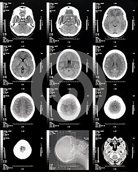 Brain CT with Scout