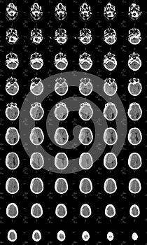 Brain CT showing intracranial bleeding photo