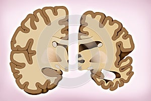 Brain difference in Alzheimer`s, This illustration shows the comparison of two halves of the brain, one healthy half and the other photo