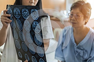 Brain disease diagnosis with medical doctor diagnosing elderly ageing patient neurodegenerative illness problem seeing MRI film