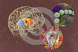 Brain disease due to streptococcal infection and anti-basal ganglia antibodies, 3D conceptual illustration