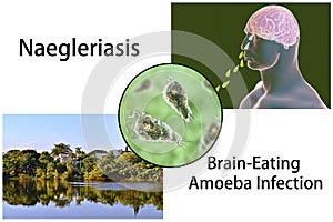 Brain-eating amoeba infection, naegleriasis