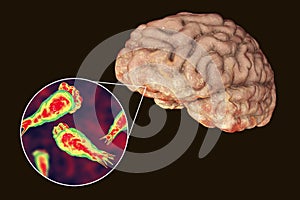 Brain-eating amoeba infection, naegleriasis