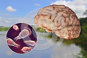 Brain-eating amoeba infection, naegleriasis