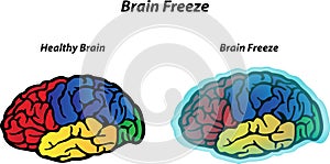 Brain Freeze