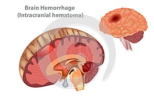 Brain Hemorrhage Intracranial hematoma photo