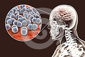 Brain infection caused by Streptococcus pneumoniae bacteria