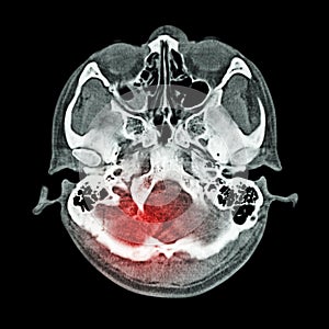 Brain injury, Stroke : ( CT scan of brain and base of skull ) ( Bone window )