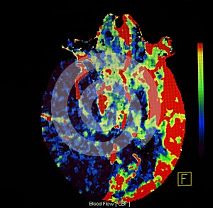 Brain ischaemic stroke. CT-scan reconstruction, perfusion..