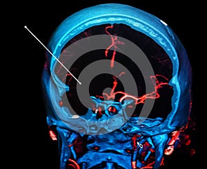 Brain ischemic stroke. CT-scan reconstruction