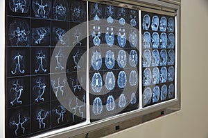 Brain magnetic resonance imaging on the lightbox