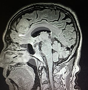 Brain meningioma pointing mri examination
