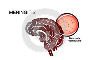 Brain, meningitis, the causative agent of meningitis photo