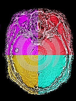 Brain MR image in different colors