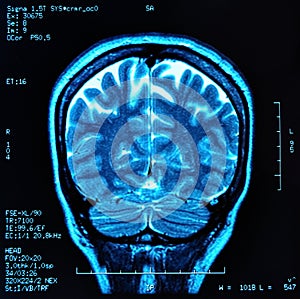 Brain MRI