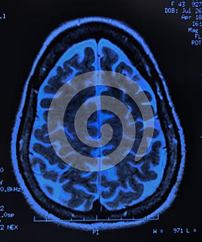 Brain MRI