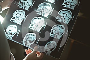 Brain MRI and dementia photo