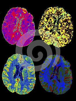 Brain, MRI, illustration