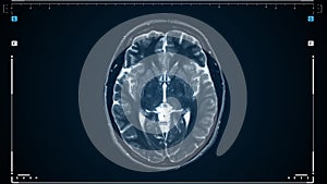 Brain MRI scan. Scanning of brain's magnetic resonance image. Diagnostic Medical Tool.