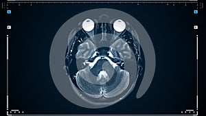 Brain MRI scan. Scanning of brain's magnetic resonance image. Diagnostic Medical Tool.