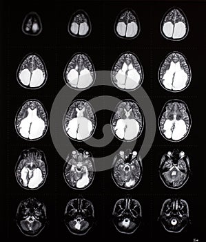 Brain mri showing enlarged ventricles