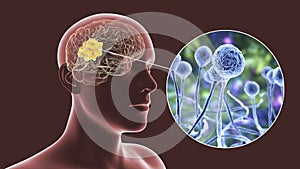 Brain mucormycosis, a brain lesion caused by fungi Mucor photo