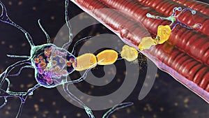 Brain neurons in Tay-Sachs disease, 3D illustration