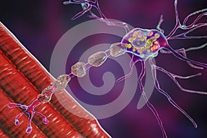Brain neurons in Tay-Sachs disease, 3D illustration photo